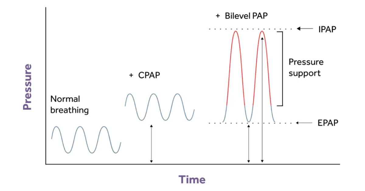 The Differences Between Cpap And Bilevel Pap Inspire Blog